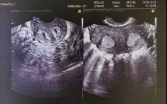 她，拆掉了子宫里的一道“墙”！